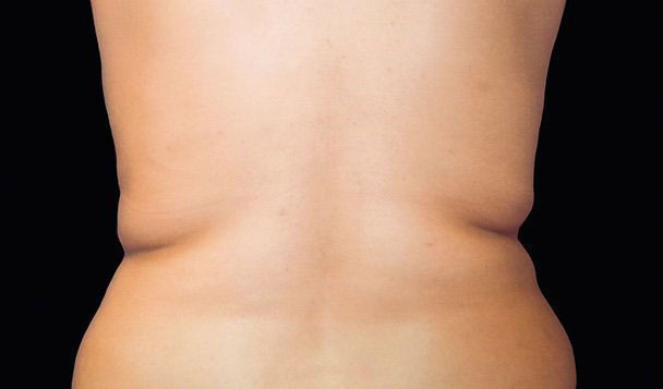 coolsculpting elite results