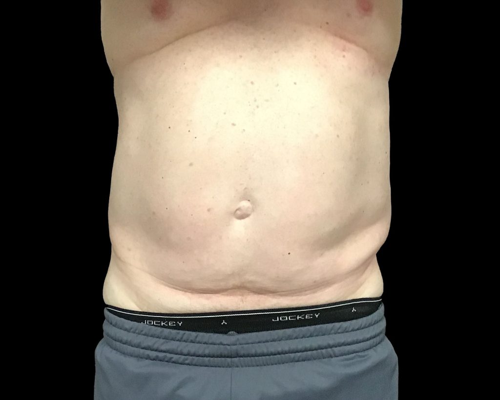 coolsculpting elite results