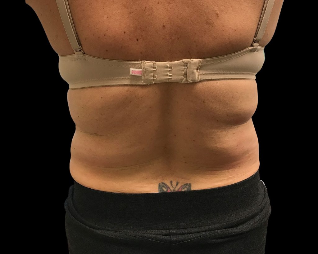 coolsculpting elite results