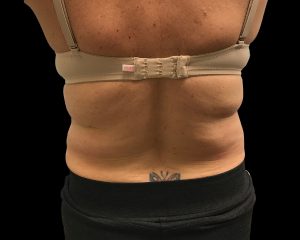 coolsculpting elite results