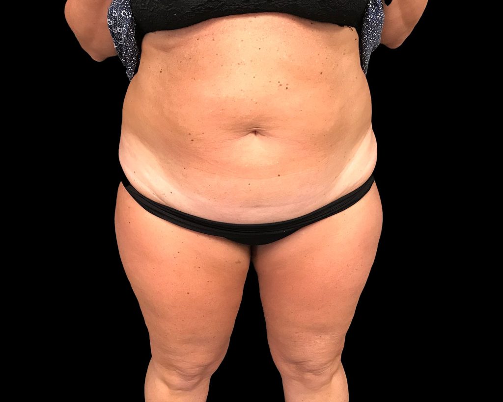 coolsculpting elite results