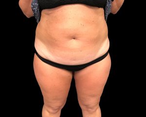 coolsculpting elite results