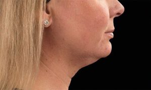 coolsculpting neck results
