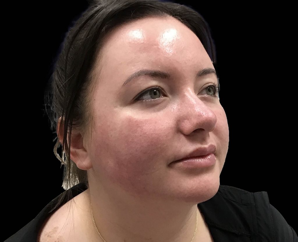 emface results