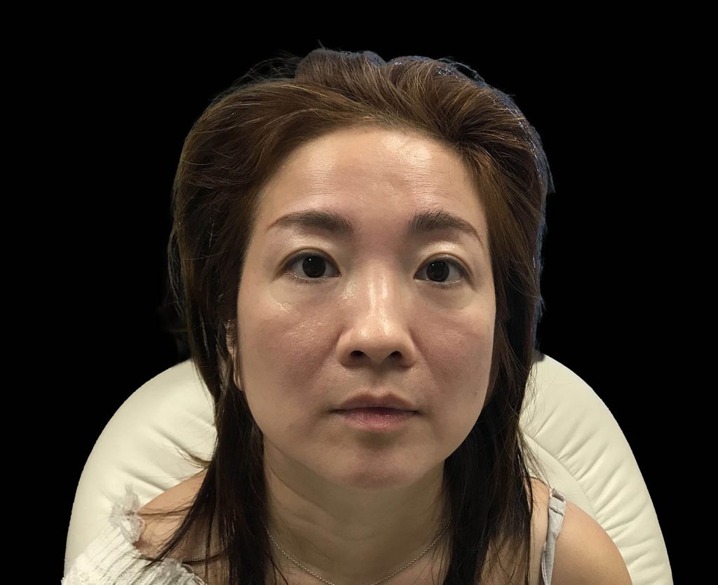 emface results