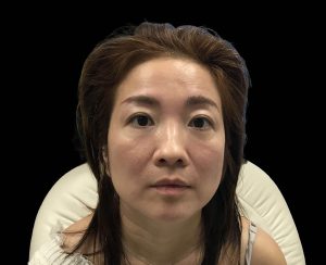 emface results