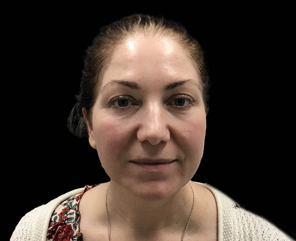 emface results