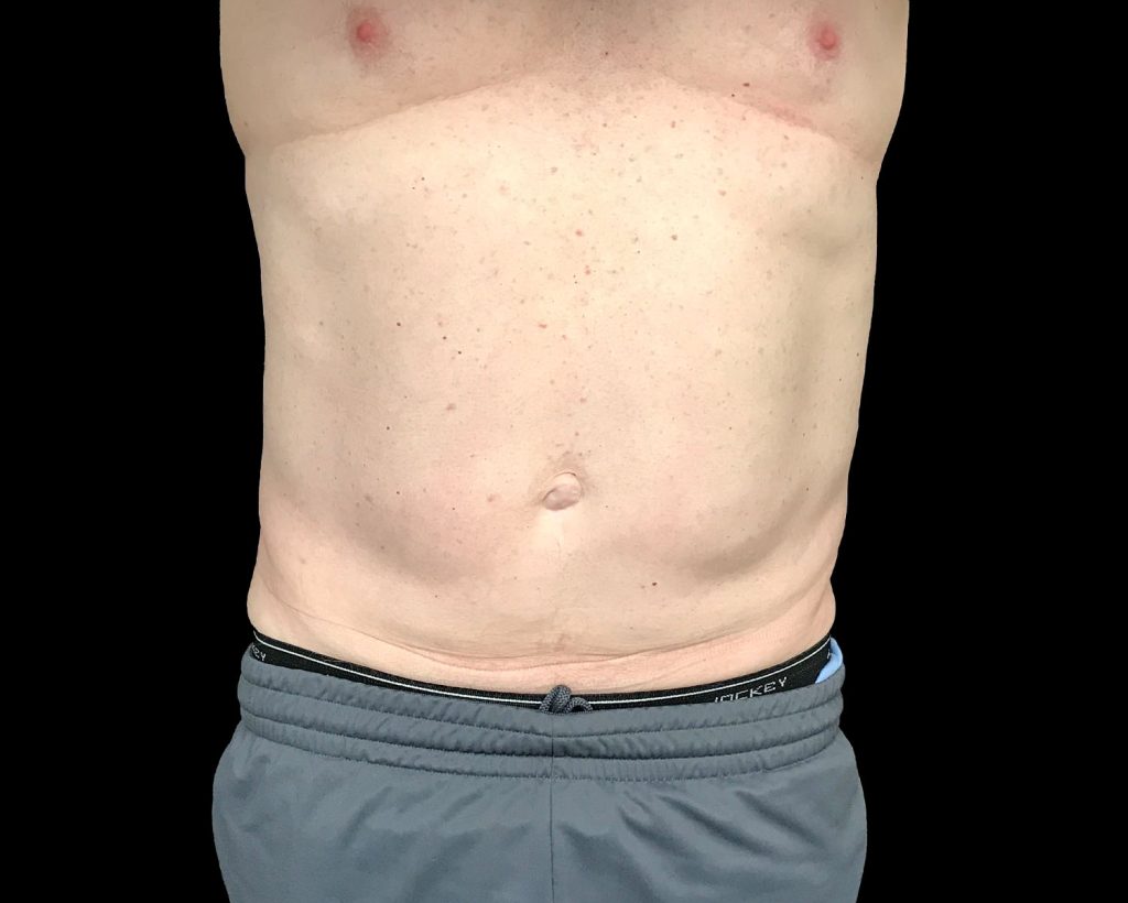 coolsculpting elite results