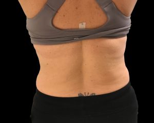 coolsculpting elite results
