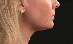 coolsculpting neck results