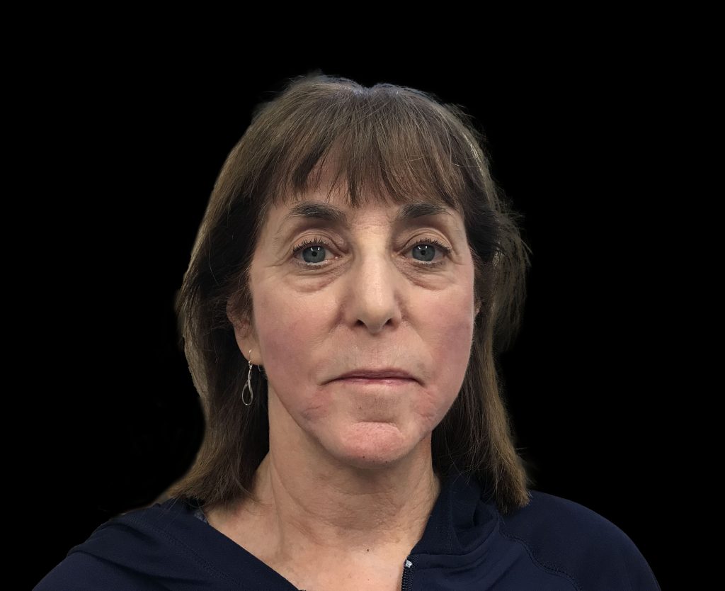 emface results