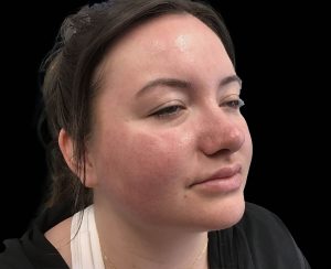 emface results