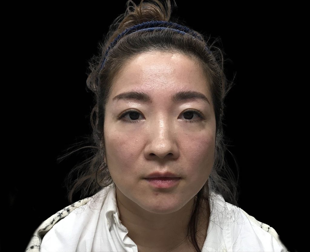 emface results