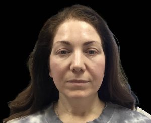 emface results