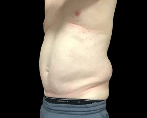 coolsculpting elite results