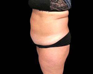 coolsculpting elite results