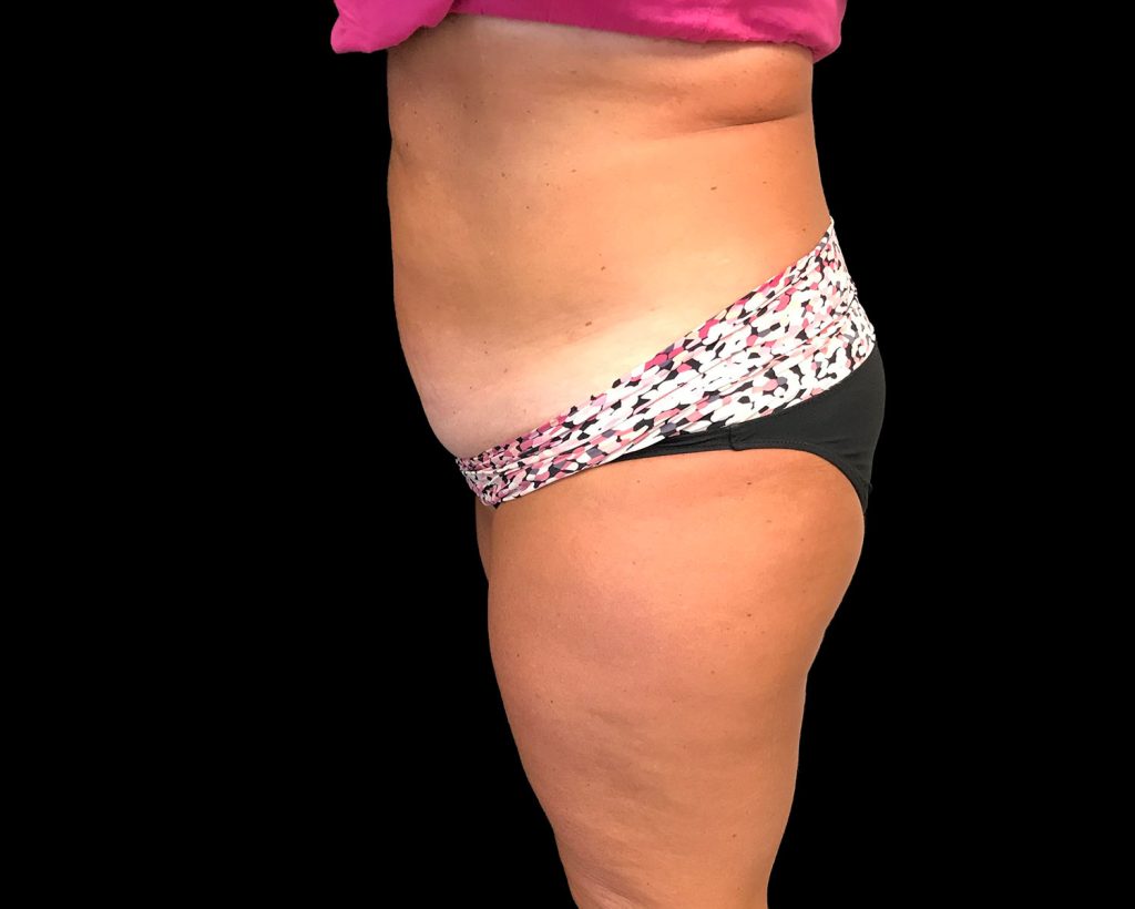 coolsculpting elite results