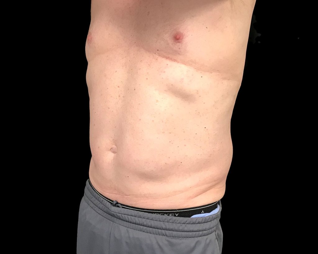 coolsculpting elite results