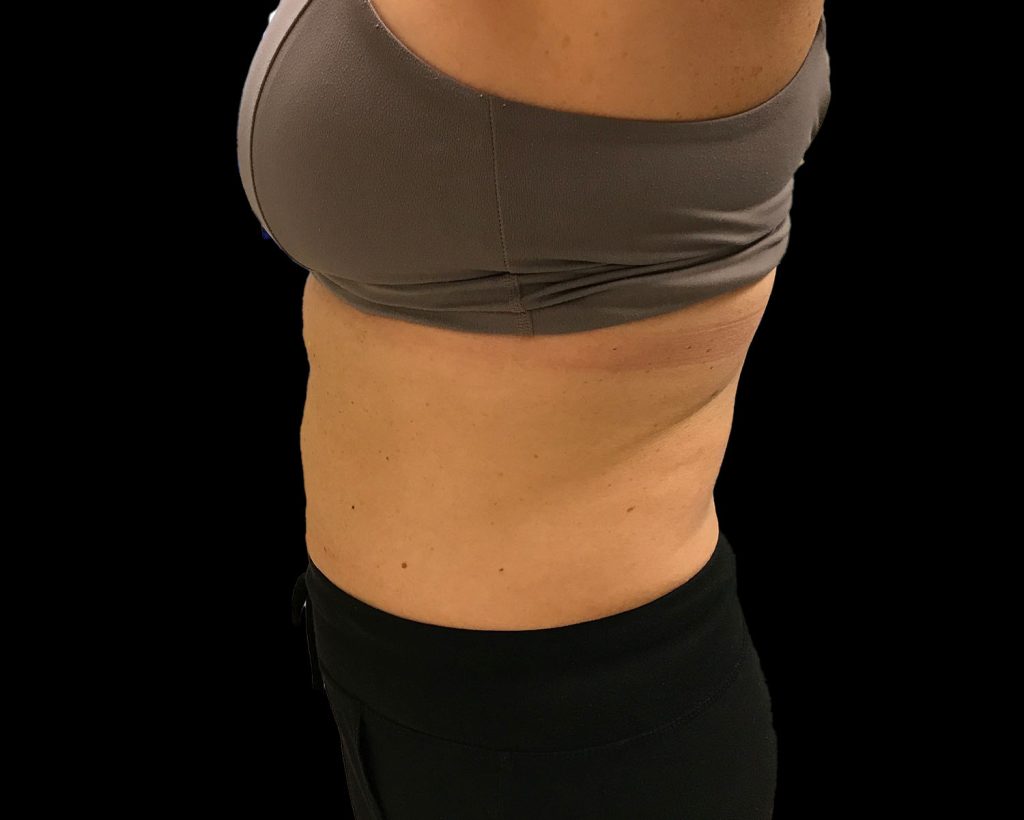 coolsculpting elite results