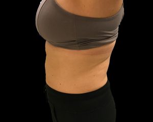 coolsculpting elite results