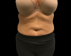 coolsculpting elite results