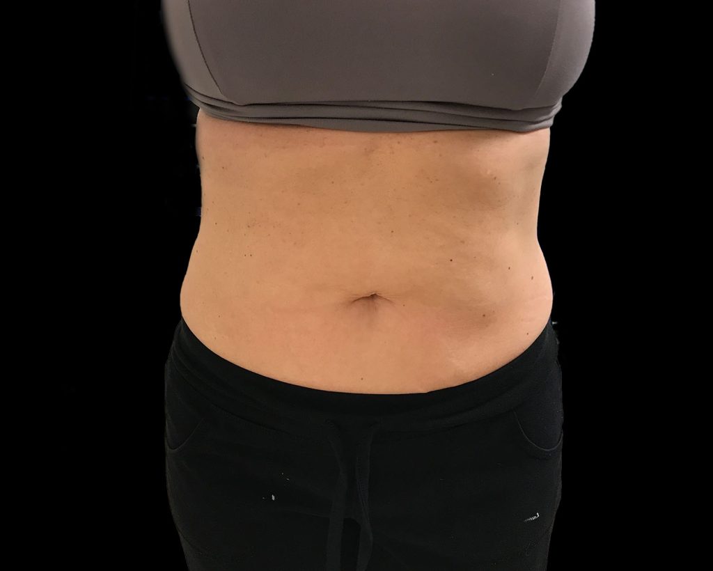 coolsculpting elite results