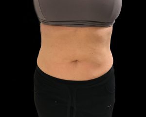 coolsculpting elite results