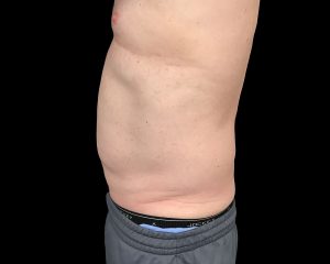 coolsculpting elite results