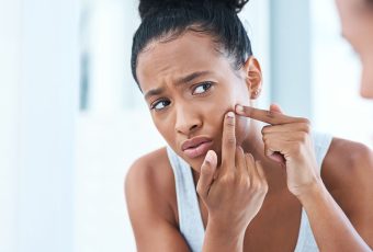AviClear for Acne-Prone Skin Types: Safe for All Tones and Textures