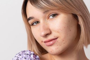 AviClear for Hormonal Acne: Treat Breakouts Without Birth Control or Accutane