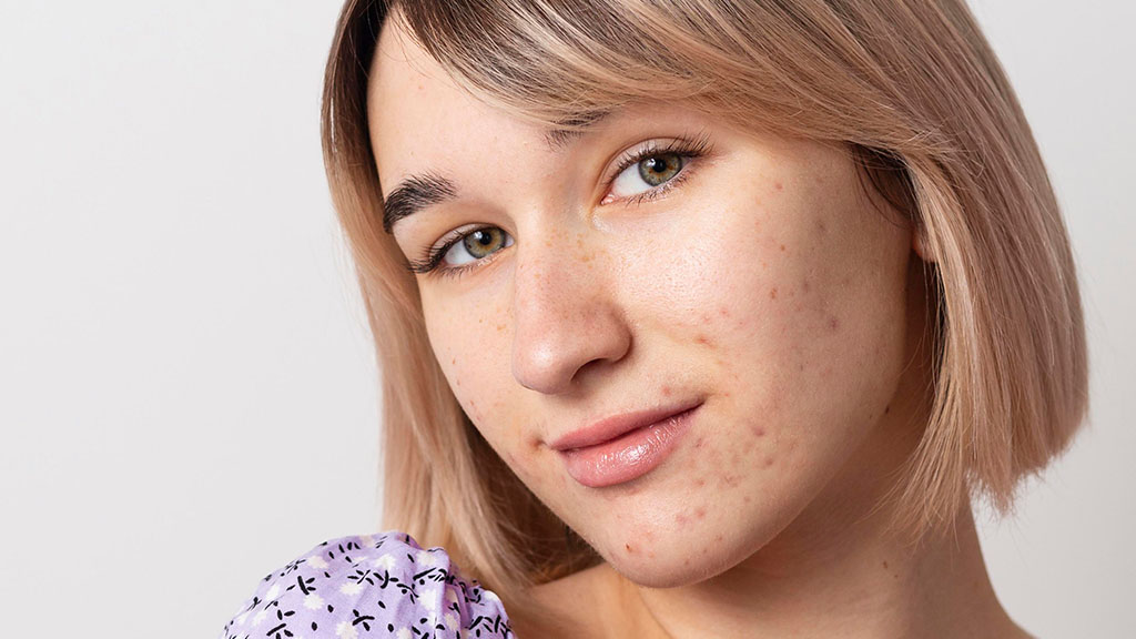 AviClear for Hormonal Acne Treat Breakouts Without Birth Control or Accutane Cincinnati