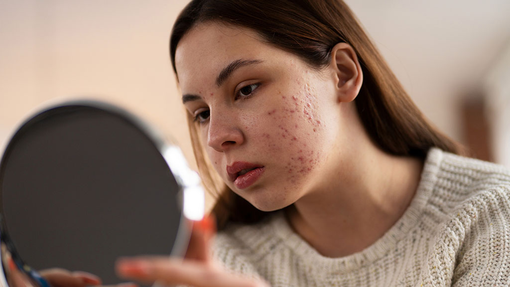 AviClear for Teen Acne A Safe, Effective Solution for Younger Skin Cincinnati