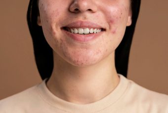 Can AviClear Help with Cystic Acne? What to Expect from This Laser Treatment