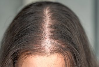 Can PRP Treat Female Pattern Hair Loss?