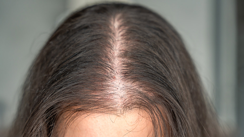Can PRP Treat Female Pattern Hair Loss Cincinnati