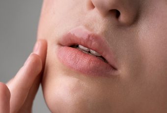 How Long Do Lip Fillers Last? Duration by Filler Type