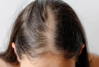 How PRP Helps with Alopecia Areata and Other Scalp Conditions
