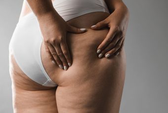 How to Treat Cellulite Without Surgery: The Ultimate Guide