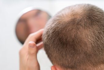 PRP for Crown Thinning and Bald Spots: Stimulate Dormant Follicles