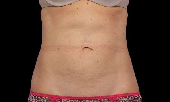 coolsculpting elite after results Cincinnati Ohio