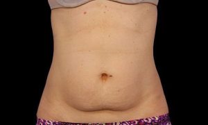 coolsculpting elite before results Cincinnati Ohio