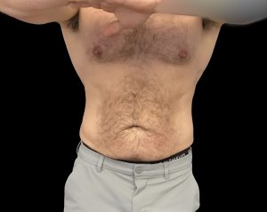 Coolsculpting elite results