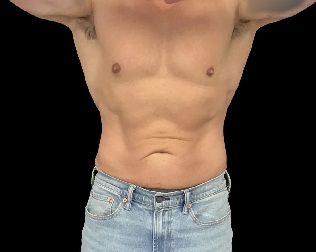 Coolsculpting elite results
