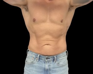 Coolsculpting elite results