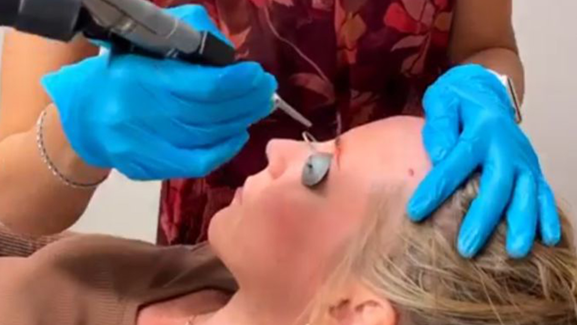 Cherry Angioma Removal with Laser: Treatment Video