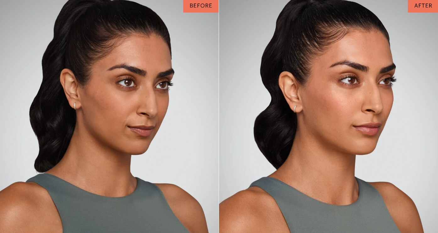 juvederm results cincinnati