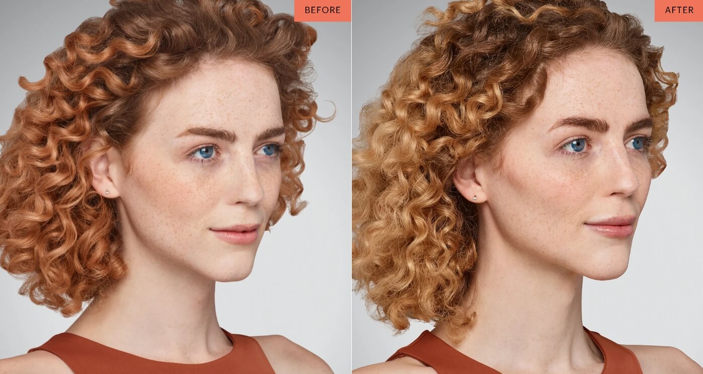 juvederm results cincinnati