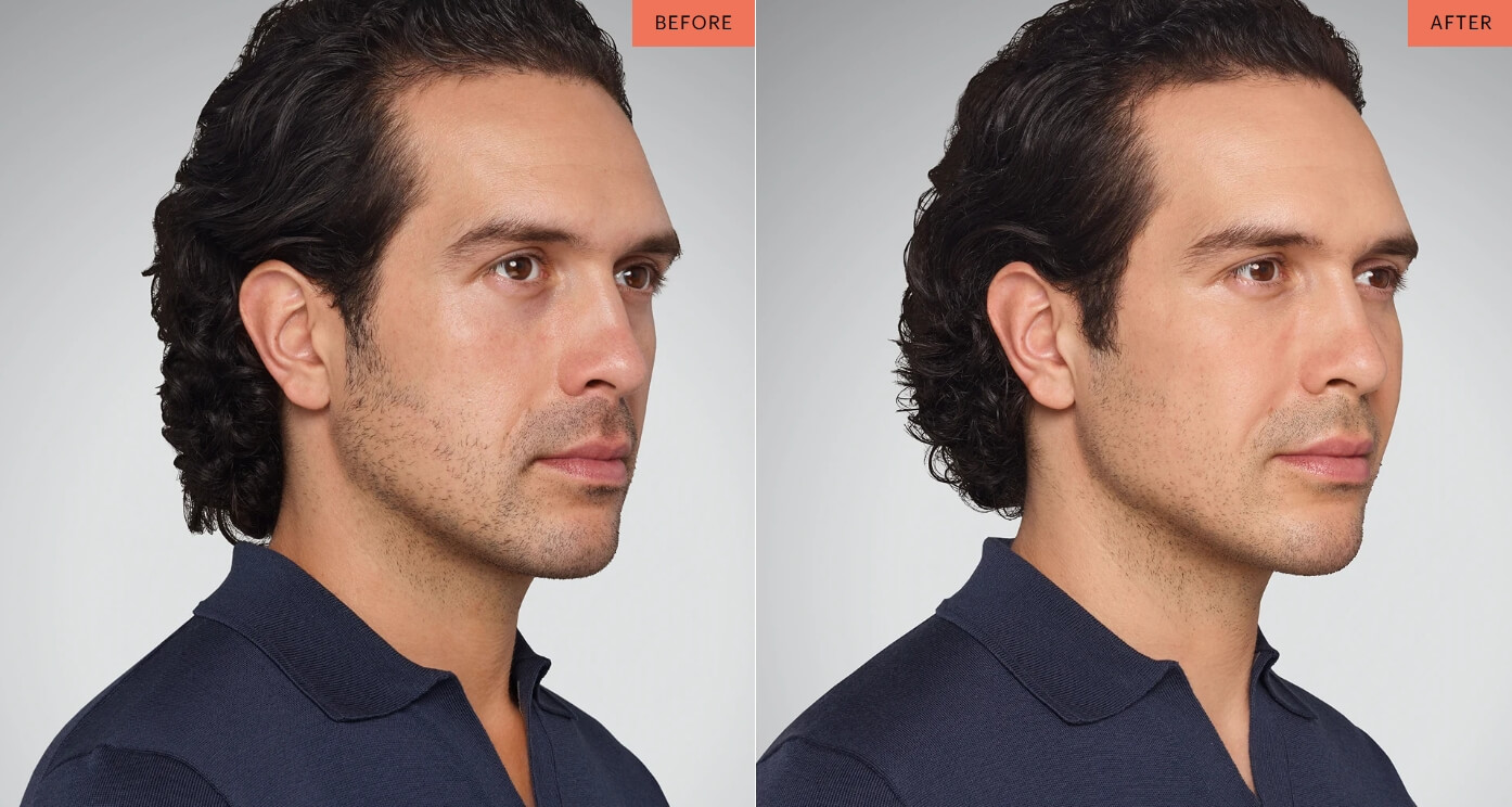 juvederm results cincinnati