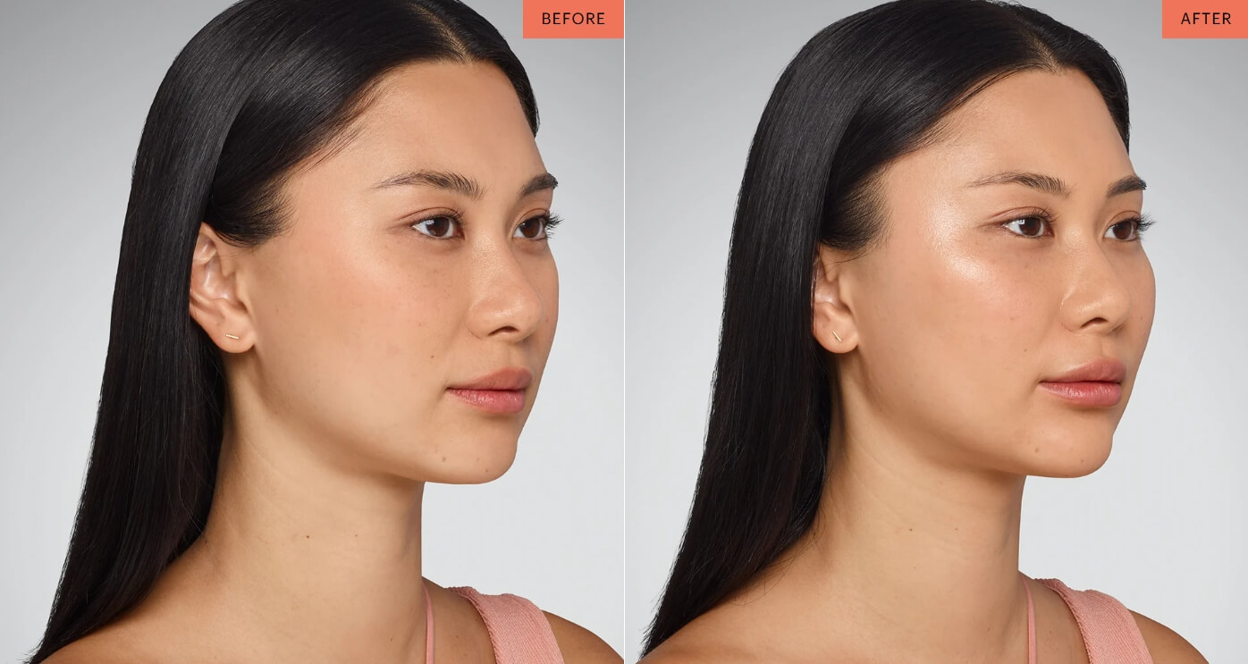 juvederm results cincinnati