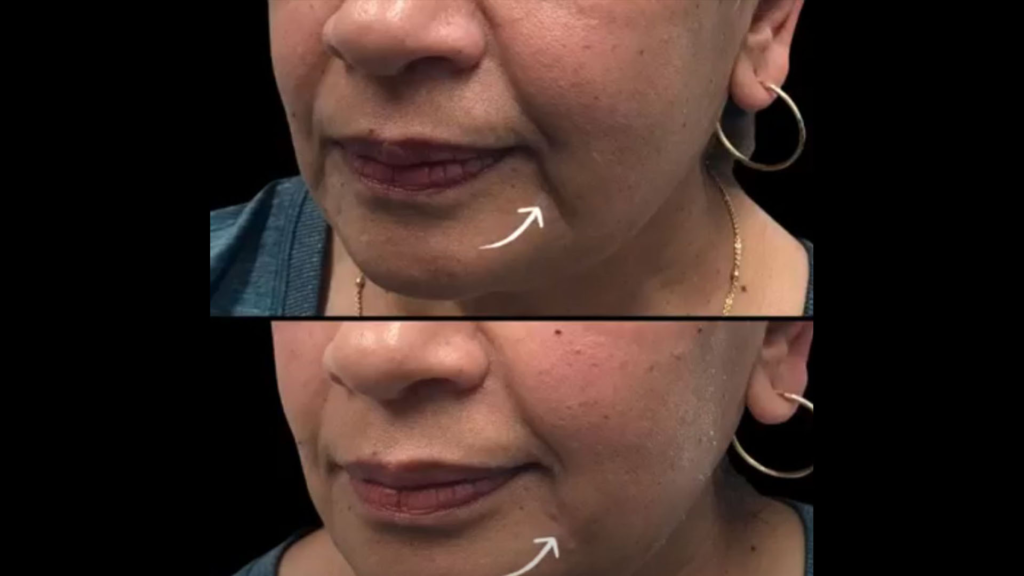 Ultherapy and Fillers The Perfect Combination for Lifting, Smoothing, and Restoring Youthful Volume